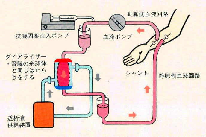 血液透析の方法