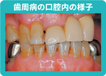 歯周病の口腔内の様子